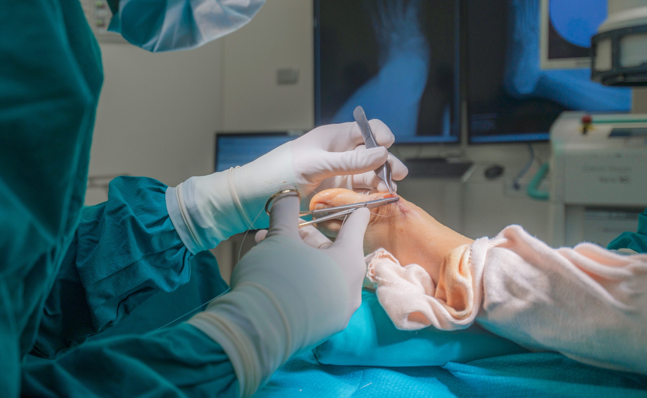 Foto de pie haciendo tratamiento Cirugía podológica