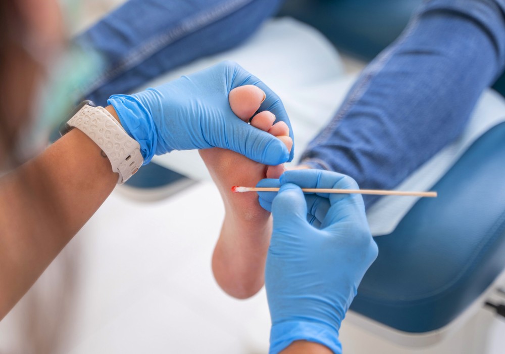 Foto pie con verruga plantar