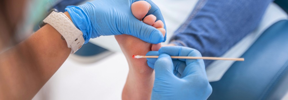 Foto pie con verruga plantar